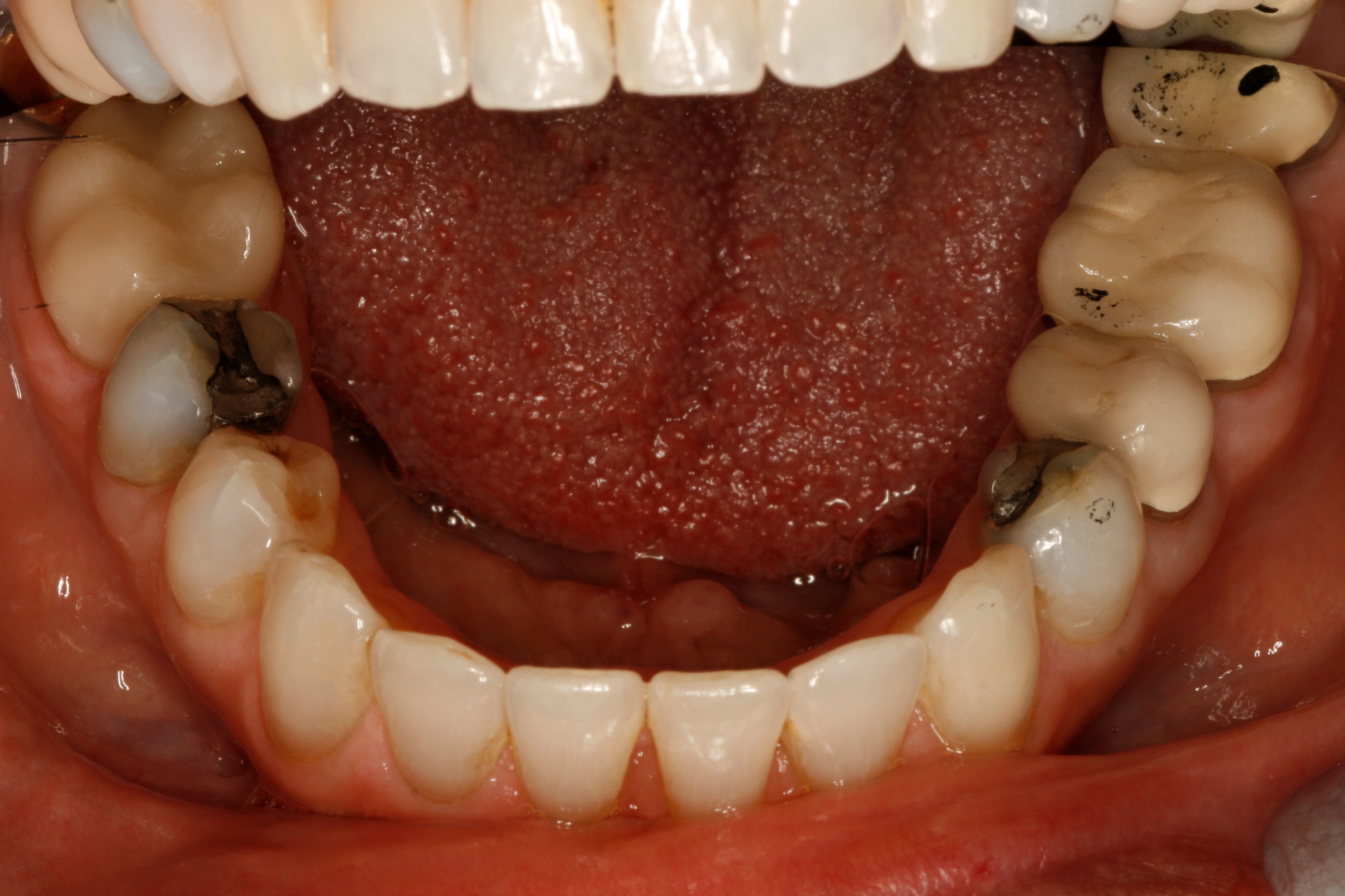 Lonnie, view of bite after cosmetic dentistry from Ponderosa Dental Group in Missoula, MT