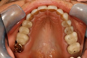After cosmetic dental surgery at Ponderosa Dental Group in Missoula, MT