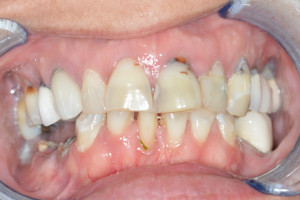 Laura, before cosmetic dentistry from Ponderosa Dental Group in Missoula, MT