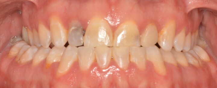 Ponderosa Dental Group cosmetic dentistry patient, before procedure